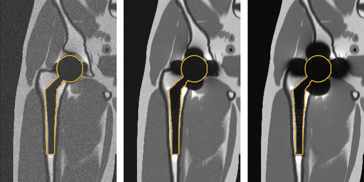 New Grant to Help Develop ‘Forever Implants’ Technology